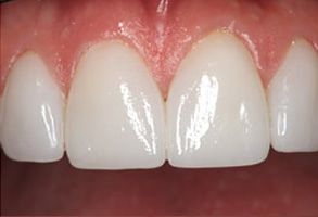 Rosenthal Dental Group | Fluoride Treatment, Laser Dentistry and Digital Impressions