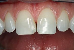 Rosenthal Dental Group | Extractions, Oral Exams and The Waterlase   Laser from Biolase